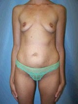 Tummy Tuck (Abdominoplasty), Breast Enhancement, Mommy Makeover