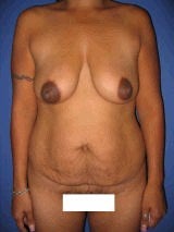 Tummy Tuck (Abdominoplasty), Breast Enhancement, Mommy Makeover