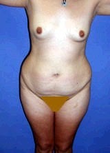 Tummy Tuck (Abdominoplasty), Mommy Makeover