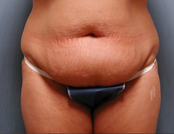 Mommy Makeover- Tummy Tuck and Breast Augmentation