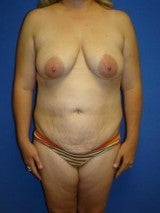 Mommy Makeover