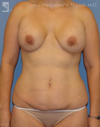 Revision of Breast & Abdominoplasty