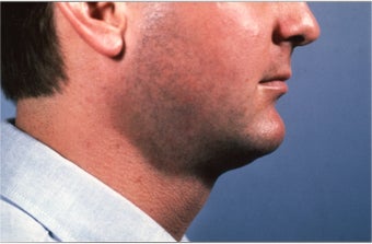 Necklift 