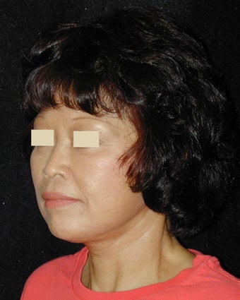 Facelift / Necklift 