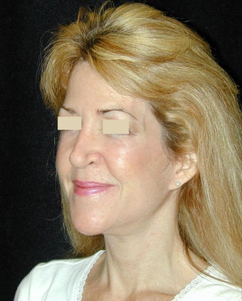 Facelift / Necklift 