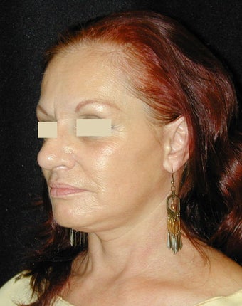 Facelift / Necklift 