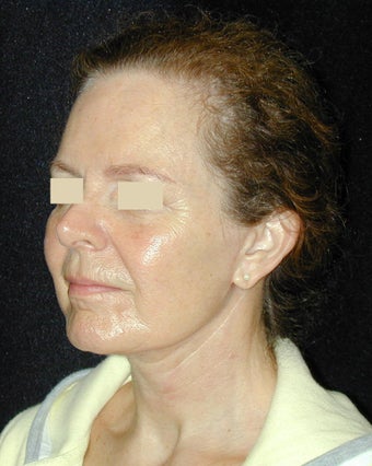Facelift / Necklift 