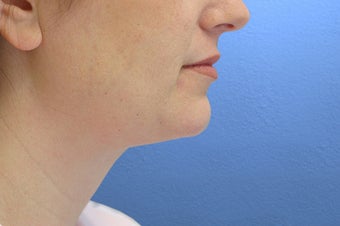 Neck Lift