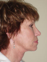 Neck Lift Surgery