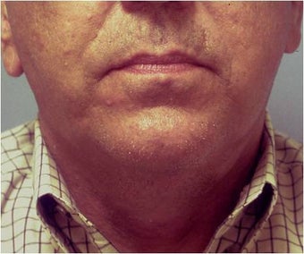 Lower face and necklift