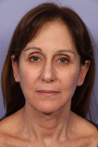 53 yr old Face and Necklift