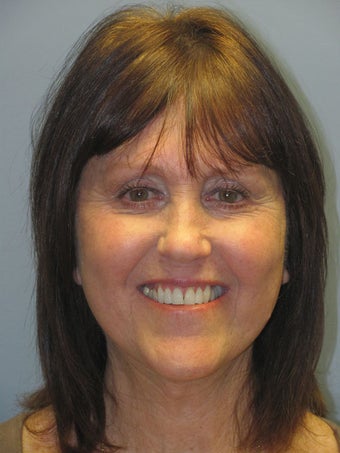 Neck Lift, Platysmaplasty