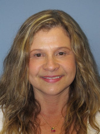 Neck Lift, Platysmaplasty