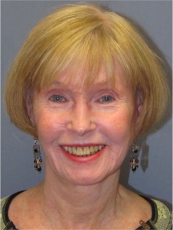 Neck Lift, Platysmaplasty