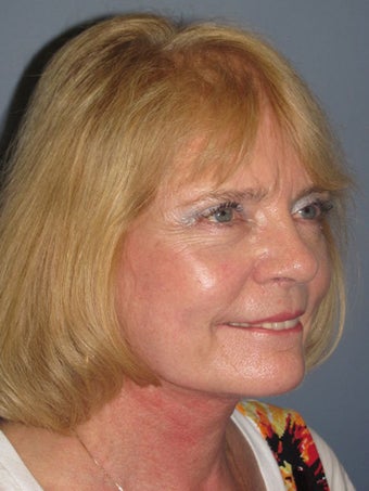 Neck Lift, Platysmaplasty