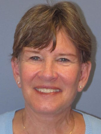 Neck Lift, Platysmaplasty