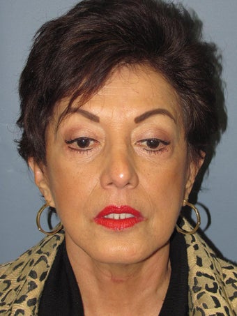 Neck Lift, Platysmaplasty
