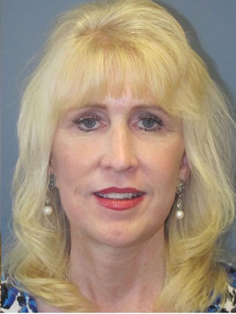 Neck Lift, Platysmaplasty