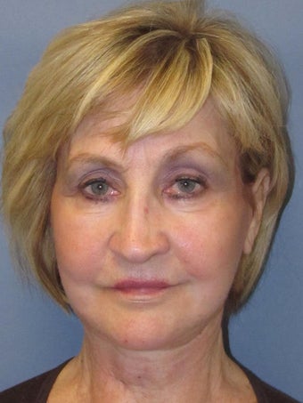 Neck Lift, Platysmaplasty