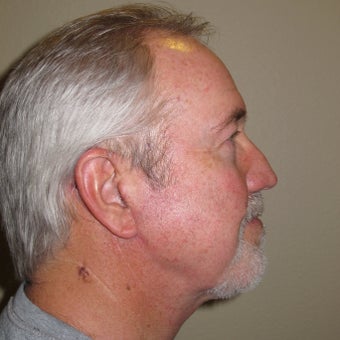Necklift