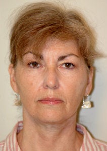 Before and After Neck Lift (Front View)