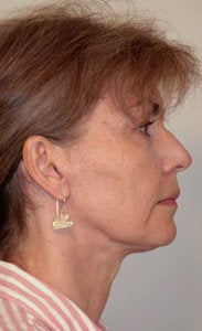 Before and After Neck Lift (Side View)
