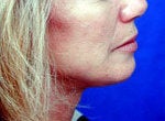 Neck Lift