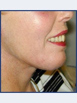 Neck Lift and Chin Implant