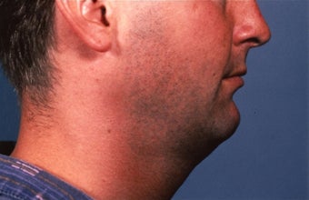 Necklift 