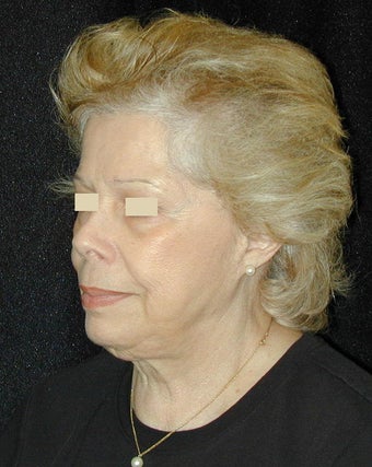 Facelift / Necklift 