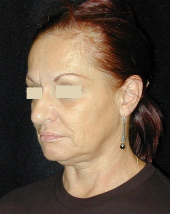 Facelift / Necklift 