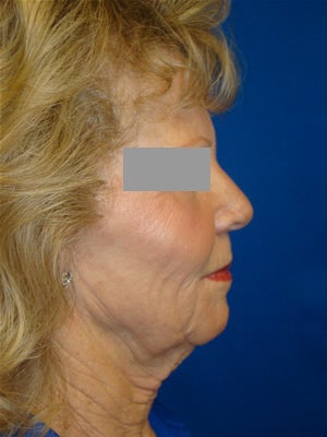 Face and Neck Lift Surgery