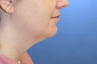 Neck Lift