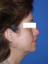 Neck Lift Surgery