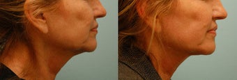 Neck Rejuvenation