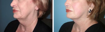 Neck lift