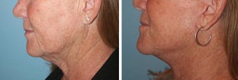 Neck lift