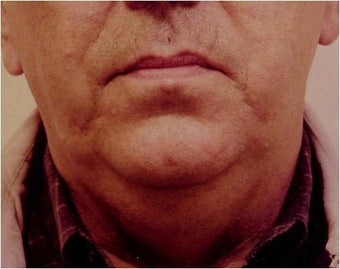 Lower face and necklift