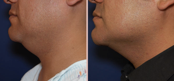 Jawline / Neck Lipo