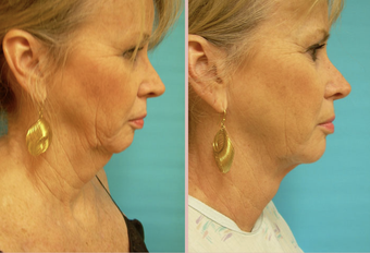 Jawline / Neck Lipo