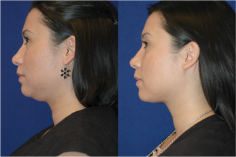 Neck Lift 