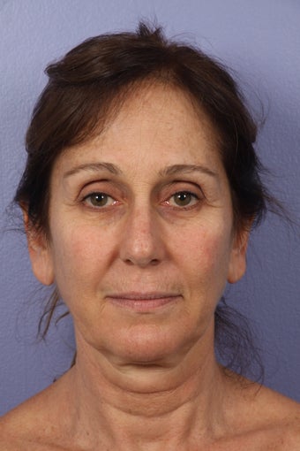 53 yr old Face and Necklift