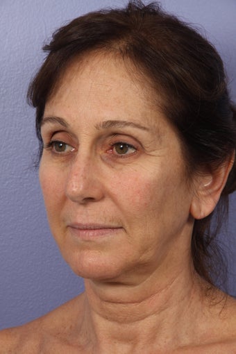 53 yr old Face and Necklift
