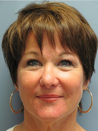 Neck Lift, Platysmaplasty