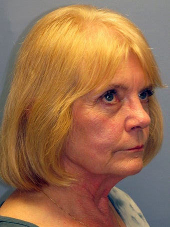 Neck Lift, Platysmaplasty