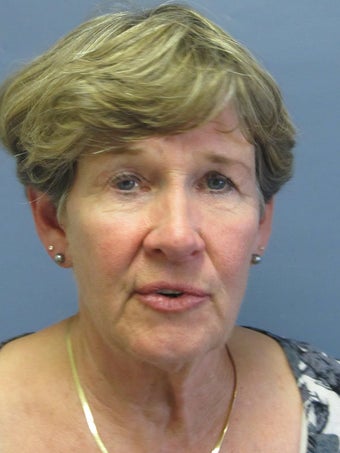 Neck Lift, Platysmaplasty