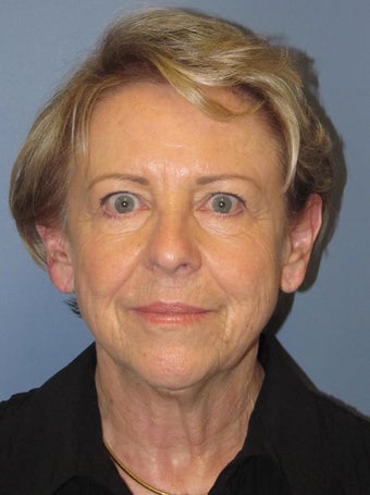 Neck Lift, Platysmaplasty