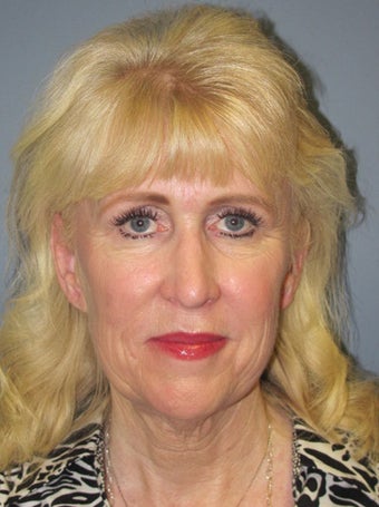 Neck Lift, Platysmaplasty