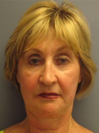 Neck Lift, Platysmaplasty