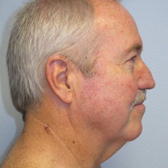 Necklift